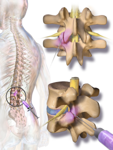 A helpful image of a facet joint injection